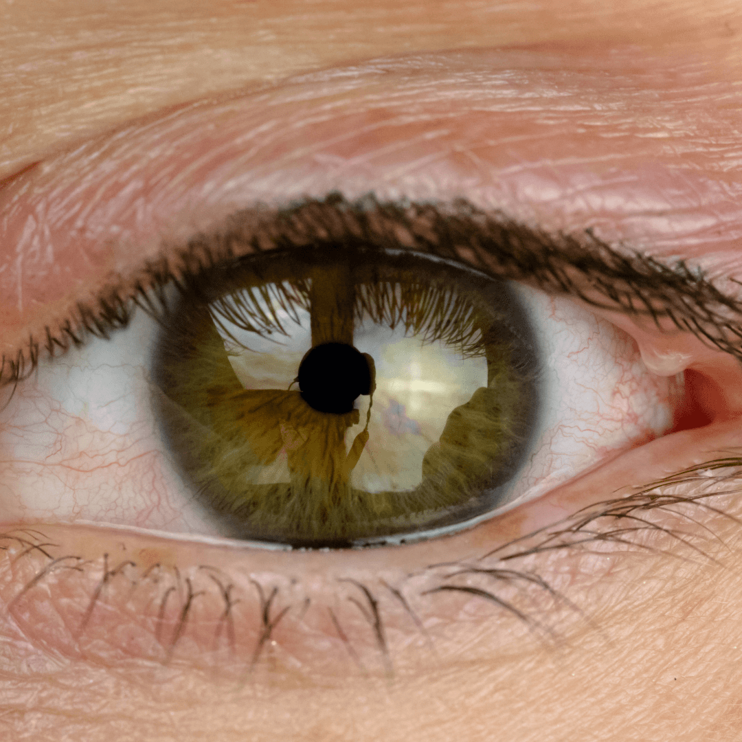 A Unique and Effective Treatment for Styes (Hordeola) at Benjamin Eye Institute