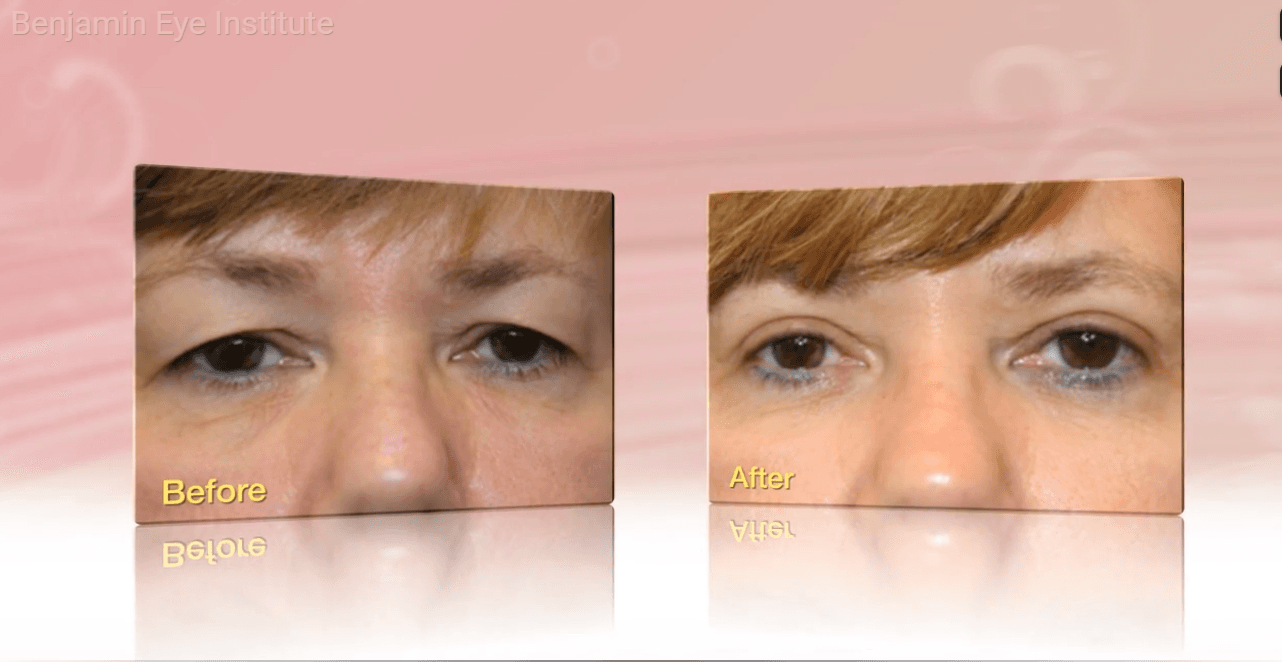 Blepharoplasty Explained: Eyelid Surgery by Dr. Arthur Benjamin in Los Angeles